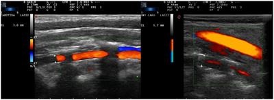 Increased vertebral canal diameter measured by ultrasonography as a sign of vasculitis in patients with giant cell arteritis